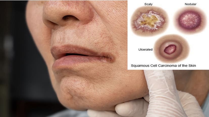 Carcinoma là ung thư gì?