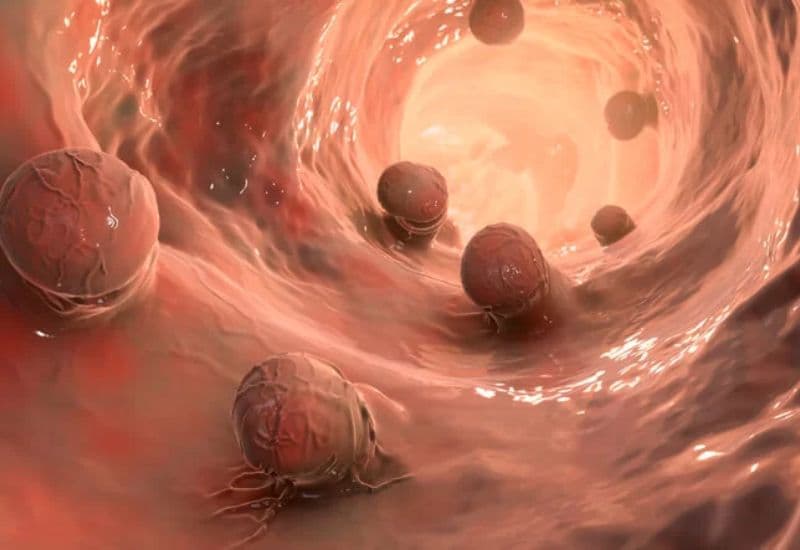 cắt polyp dạ dày có mọc lại không