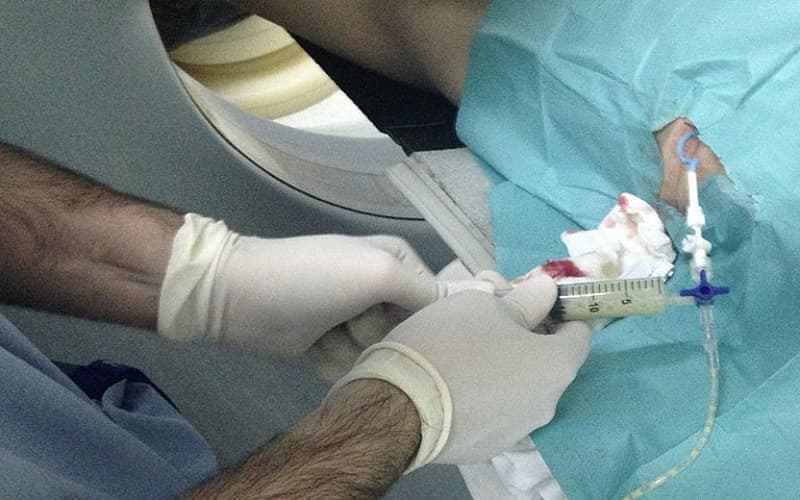 dẫn lưu áp xe gan