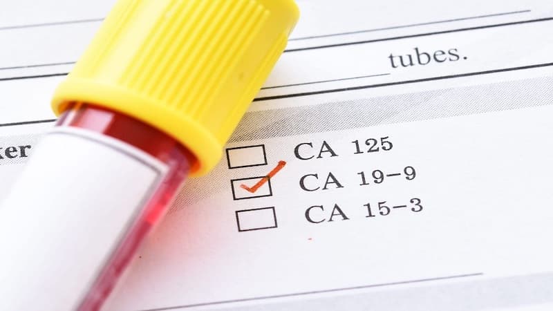 chỉ số ca 19-9 bao nhiêu là ung thư