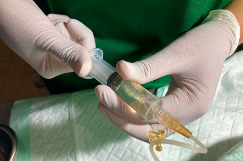 vị trí chọc dịch ổ bụng