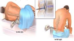 Chọc tủy xét nghiệm viêm màng não