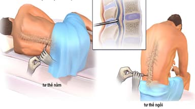 Chọc tủy xét nghiệm viêm màng não