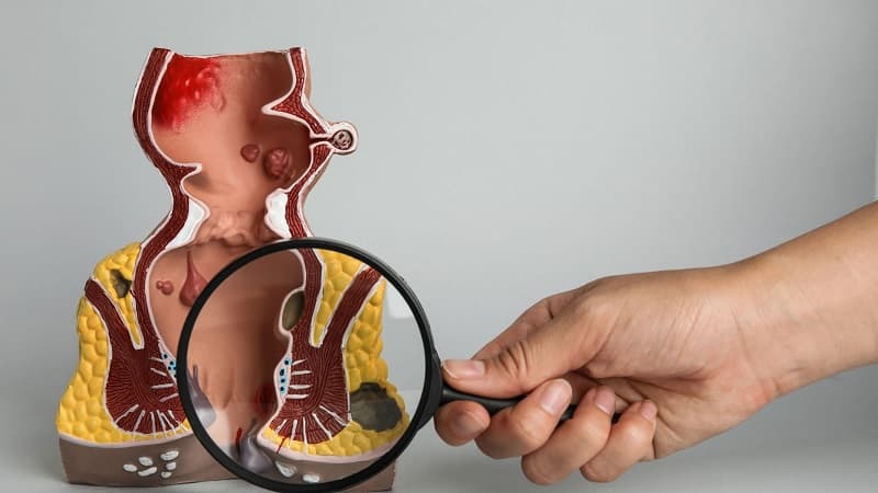 nếp da thừa hậu môn