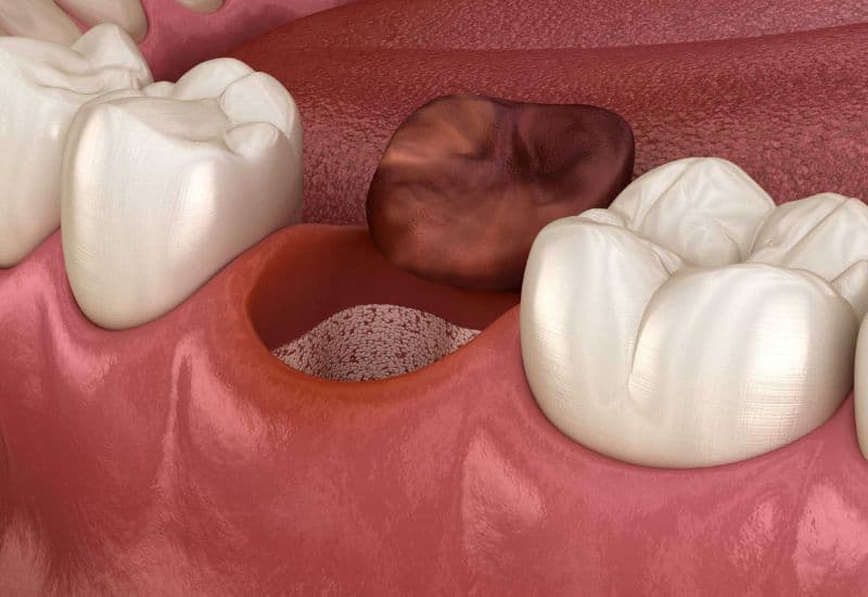 dấu hiệu nguy hiểm sau khi nhổ răng khôn