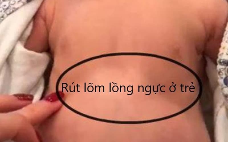 dấu hiệu suy hô hấp ở trẻ