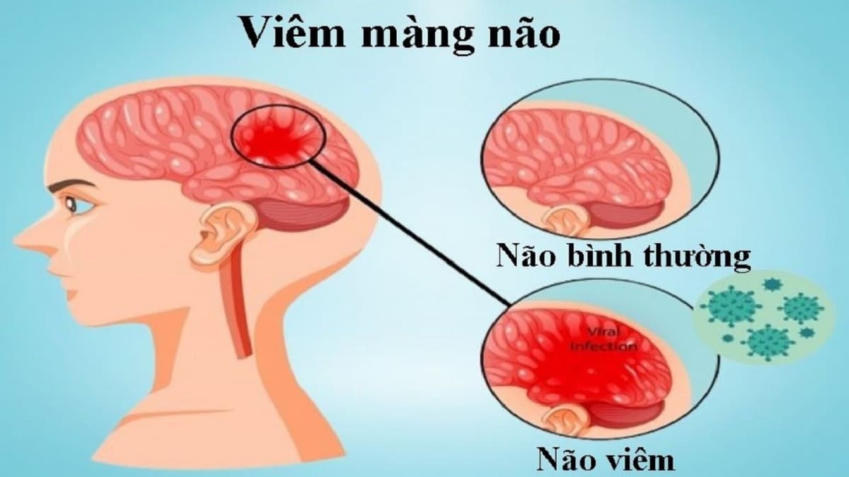 Dấu hiệu viêm màng não ở người lớn