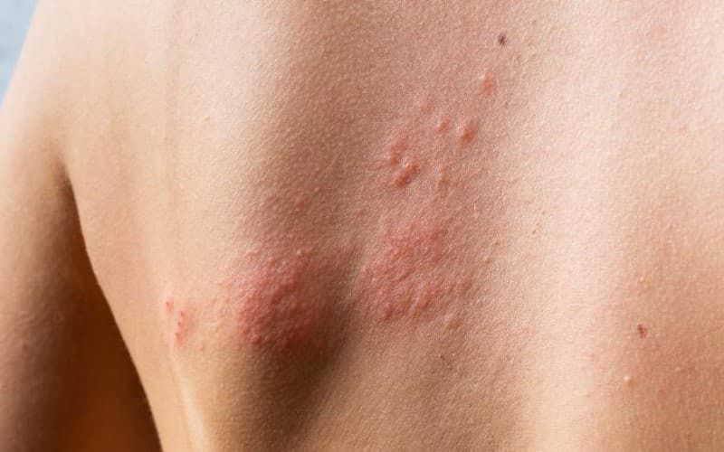 dị ứng thuốc kháng sinh amoxicillin