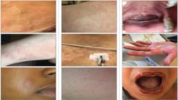 Dị ứng Ampicillin: Triệu chứng, nguyên nhân