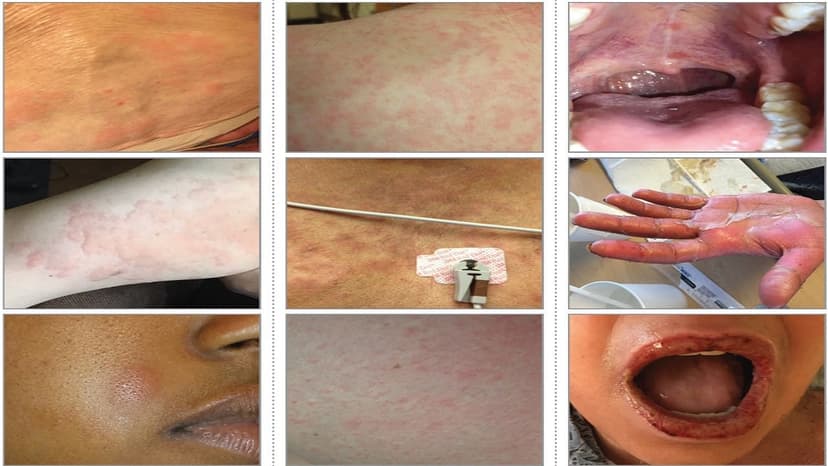 Dị ứng Ampicillin: Triệu chứng, nguyên nhân