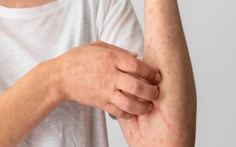 dị ứng thuốc kháng sinh amoxicillin