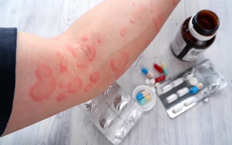 dị ứng ampicillin