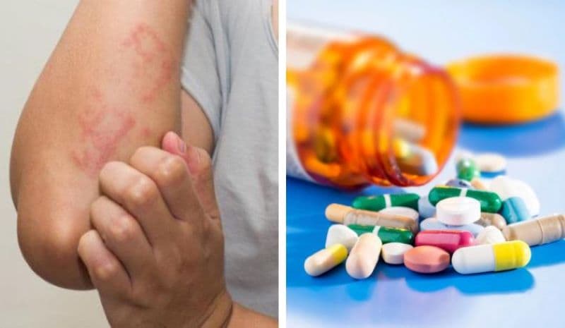 bị dị ứng thuốc kháng sinh nên làm gì
