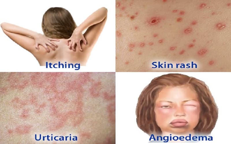 dị ứng penicillin