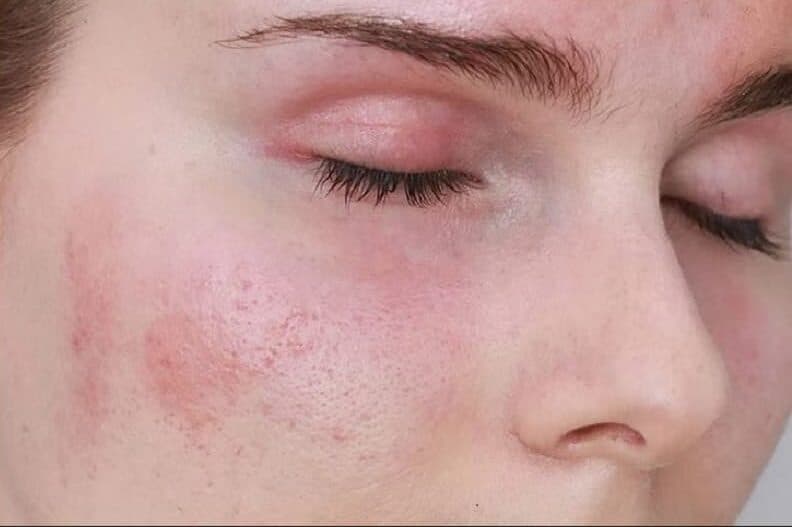 dị ứng thuốc kháng sinh sưng mắt