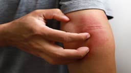 Làm gì khi bị dị ứng thuốc kháng sinh amoxicillin?