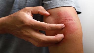 Làm gì khi bị dị ứng thuốc kháng sinh amoxicillin?