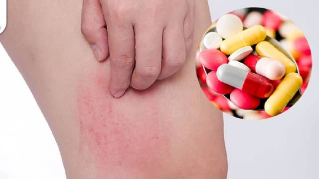 Vì sao dị ứng thuốc kháng sinh gây ngứa?