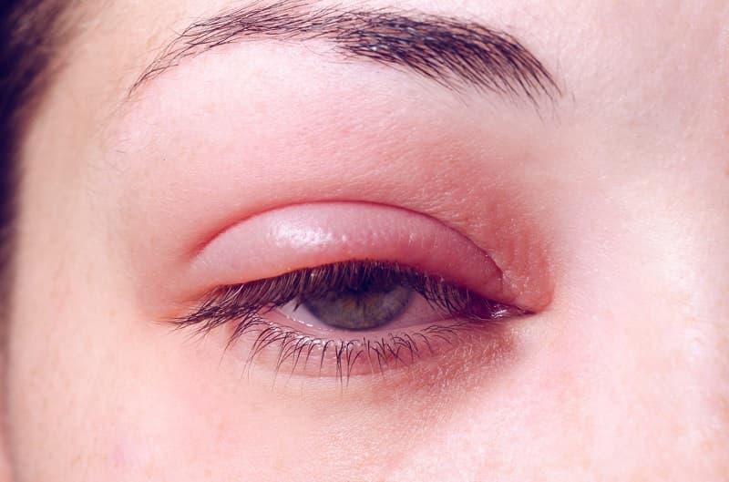 dị ứng thuốc kháng sinh sưng mắt