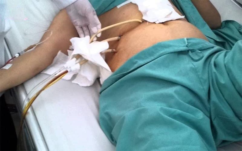 áp xe gan do sán lá gan lớn