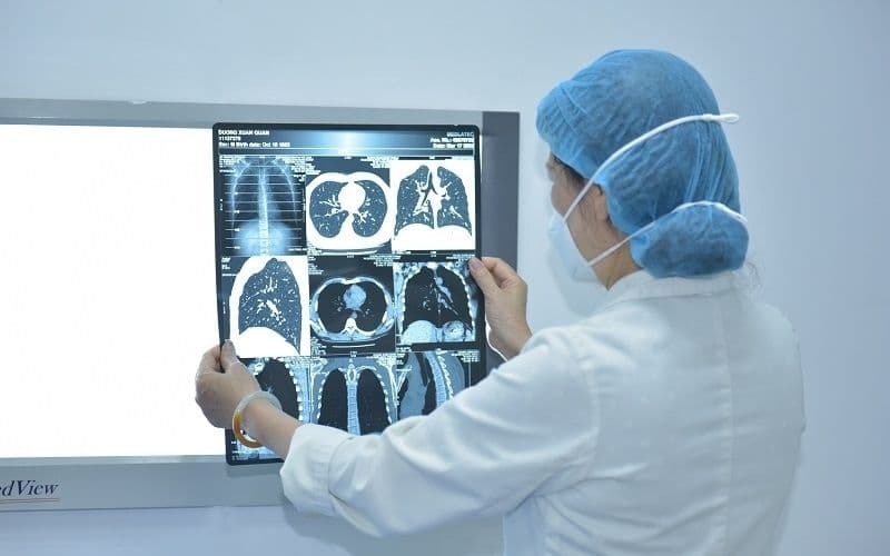 phẫu thuật ung thư phổi giai đoạn đầu