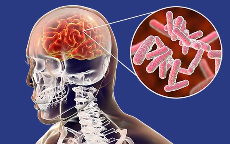 phác đồ điều trị viêm màng não người lớn