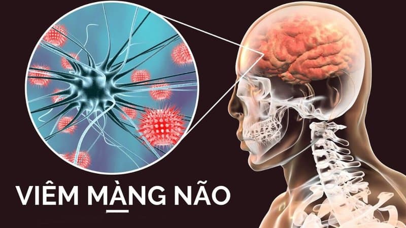 viêm màng não do vi khuẩn