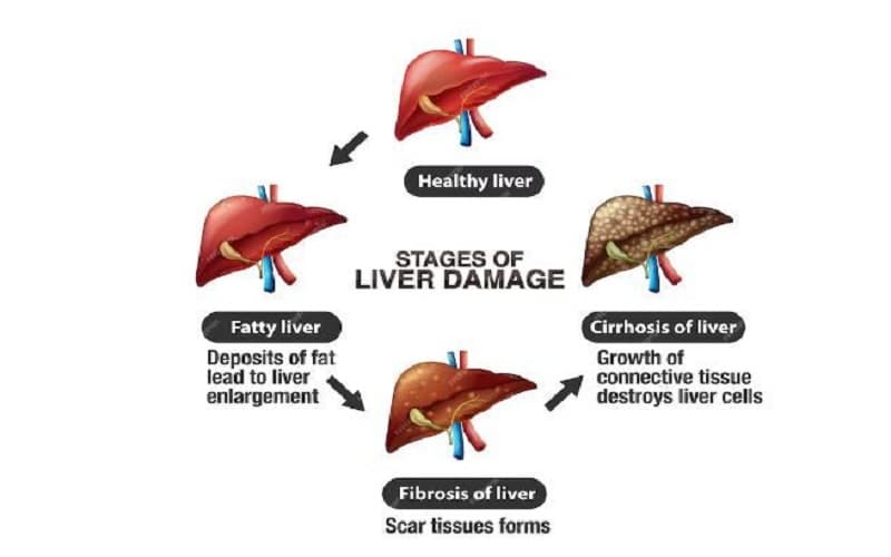 chỉ số GGT trong máu cao