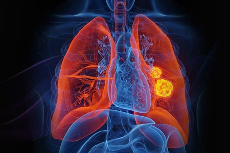 quy trình tầm soát ung thư phổi