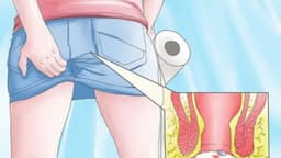 Làm gì khi hậu môn ẩm ướt ngứa ngáy?