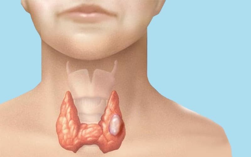 nội soi họng có phát hiện u tuyến giáp không