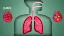 Hội chứng suy hô hấp cấp tiến triển ARDS