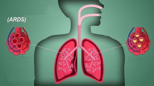 Hội chứng suy hô hấp cấp tiến triển ARDS