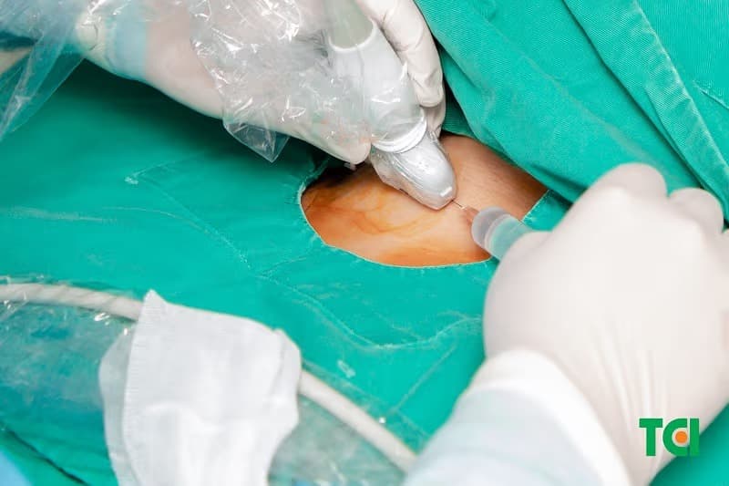 u tuyến giáp tirads 4 là gì