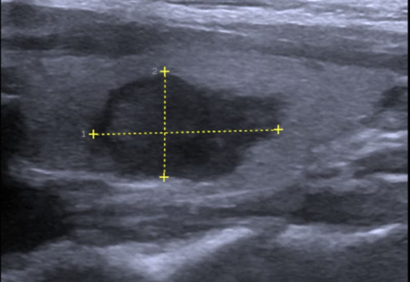 siêu âm tuyến giáp có phát hiện ung thư