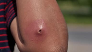 Có nên dùng kháng sinh bôi áp xe?