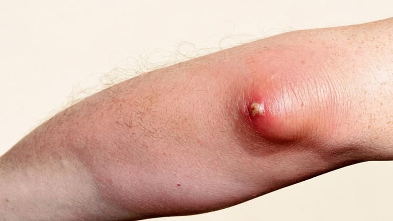 kháng sinh bôi áp xe