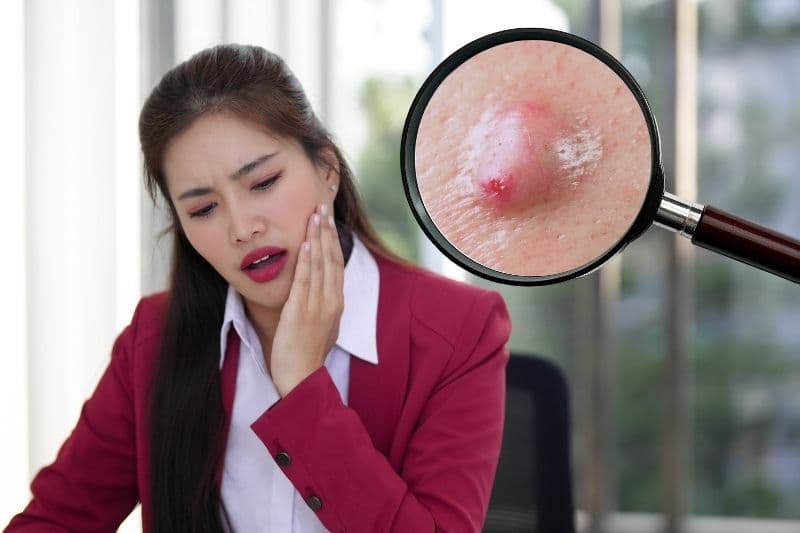 làm má lúm bị áp xe