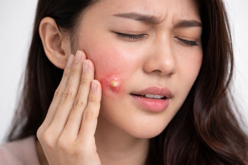 làm má lúm bị áp xe