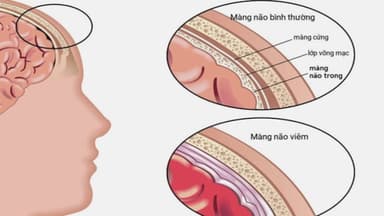 Liều Ceftriaxone viêm màng não