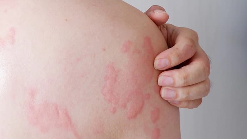 thuốc kháng Histamin h1 thế hệ 2