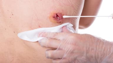 Giải đáp thắc mắc về mổ áp xe là gì và có nguy hiểm không