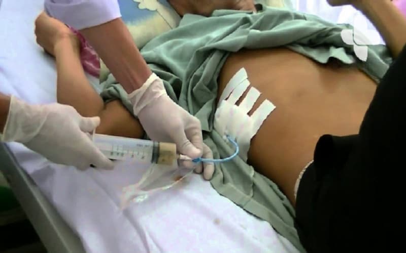 dẫn lưu áp xe gan