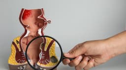 Mổ rò hậu môn bao lâu thì quan hệ được?