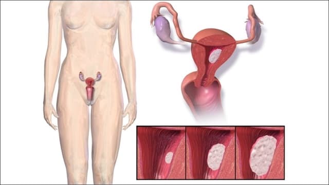 Nguyên nhân tăng sinh mạch máu cổ tử cung