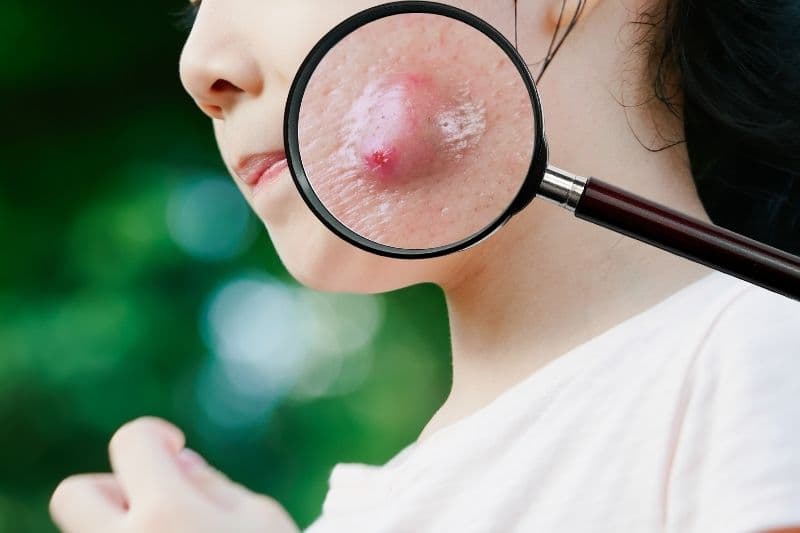 làm má lúm bị áp xe