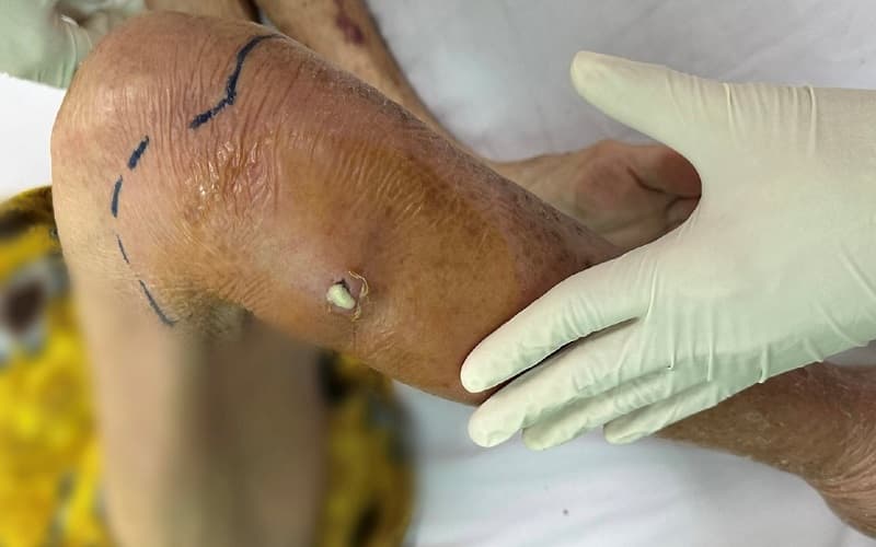 bệnh nhiễm trùng máu có lây không