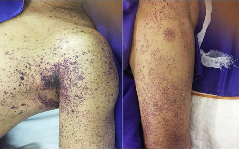 bệnh nhiễm trùng máu có lây không