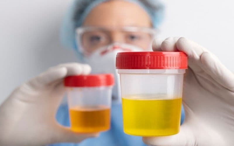 nước tiểu đổi màu