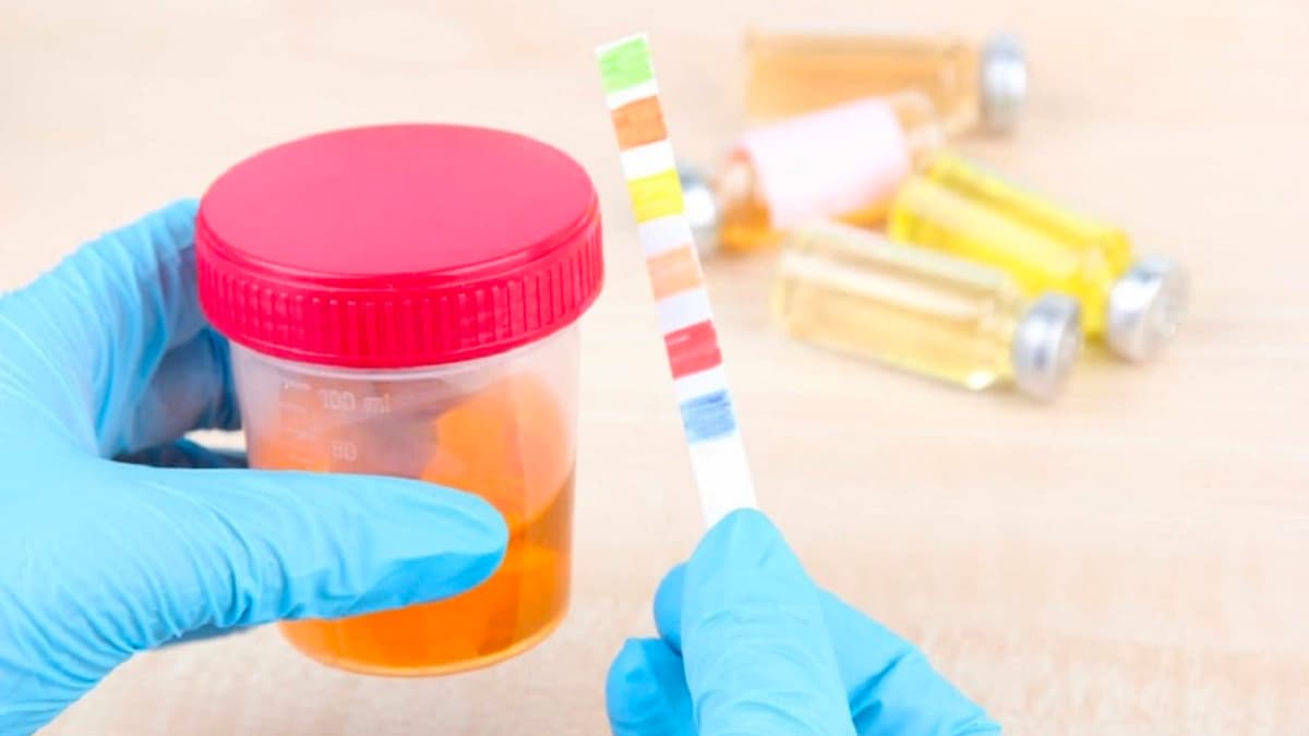 Giải đáp: Nước tiểu màu cam ở nữ là gì?